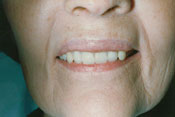 11-AFTER