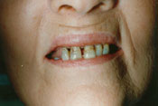 11-BEFORE