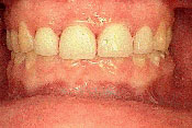 6-AFTER