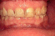 6-BEFORE