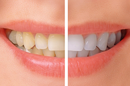 Tooth Whitening